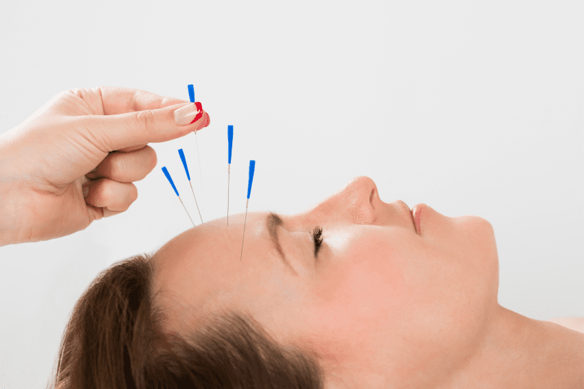 Face acupuncture
