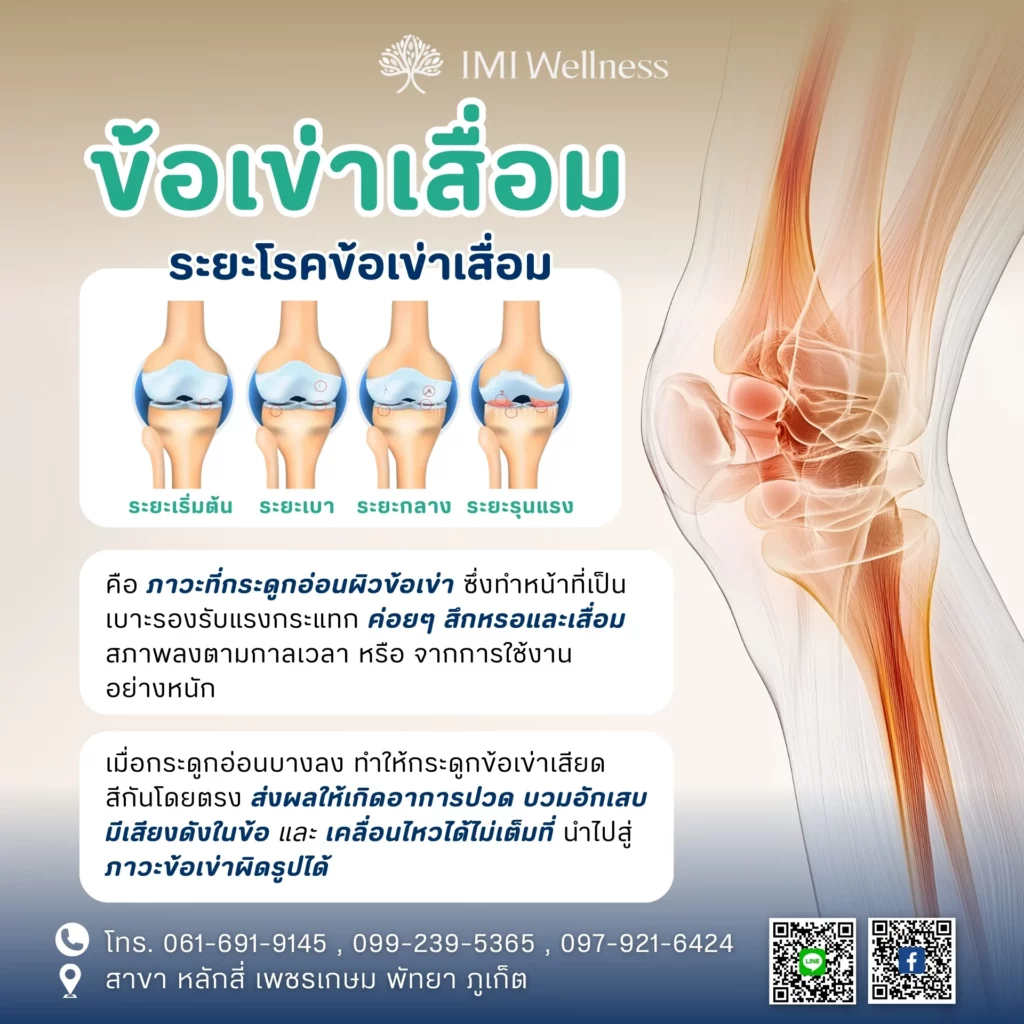 ฝังเข็มหัวเข่า