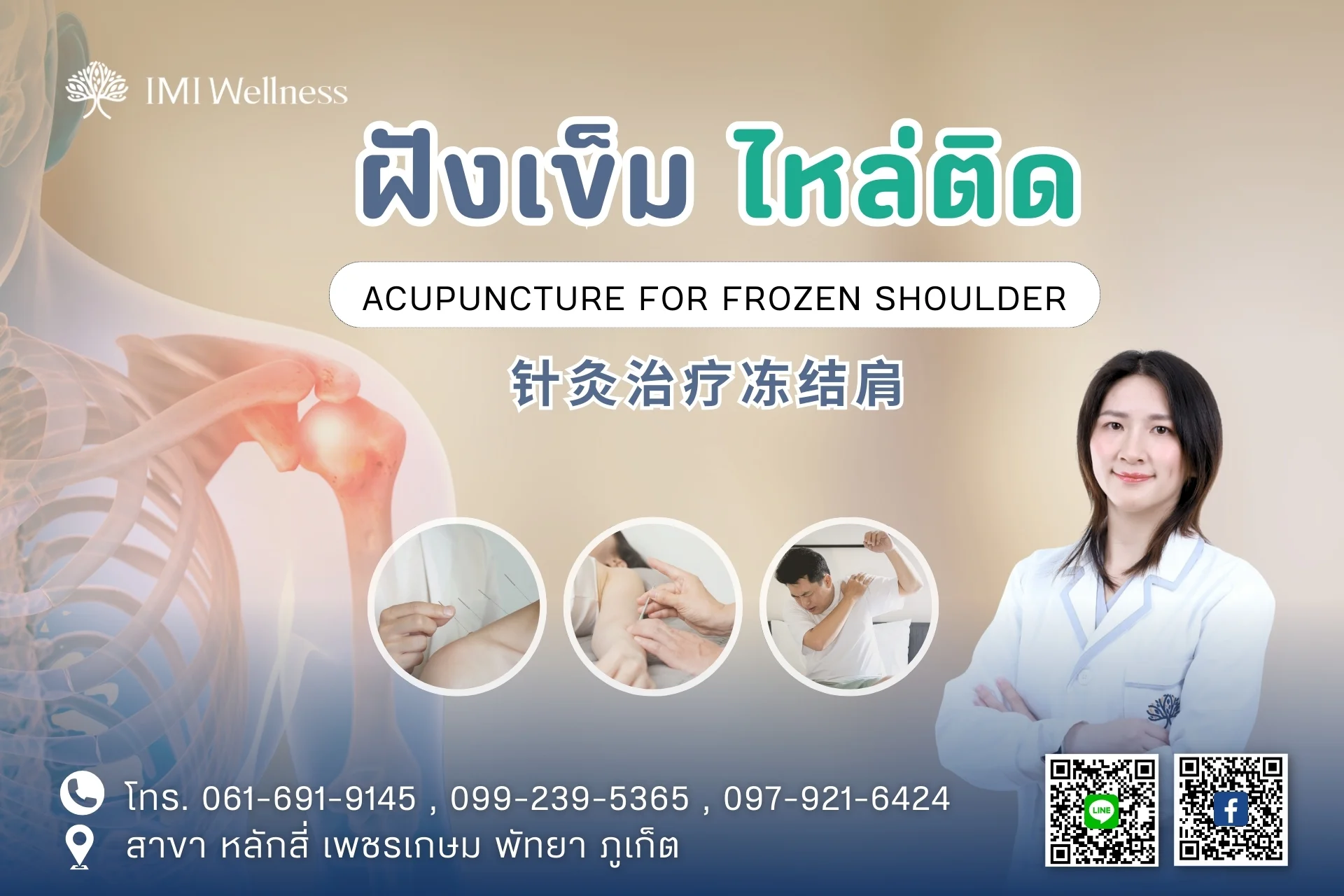 ฝังเข็มไหล่ติด