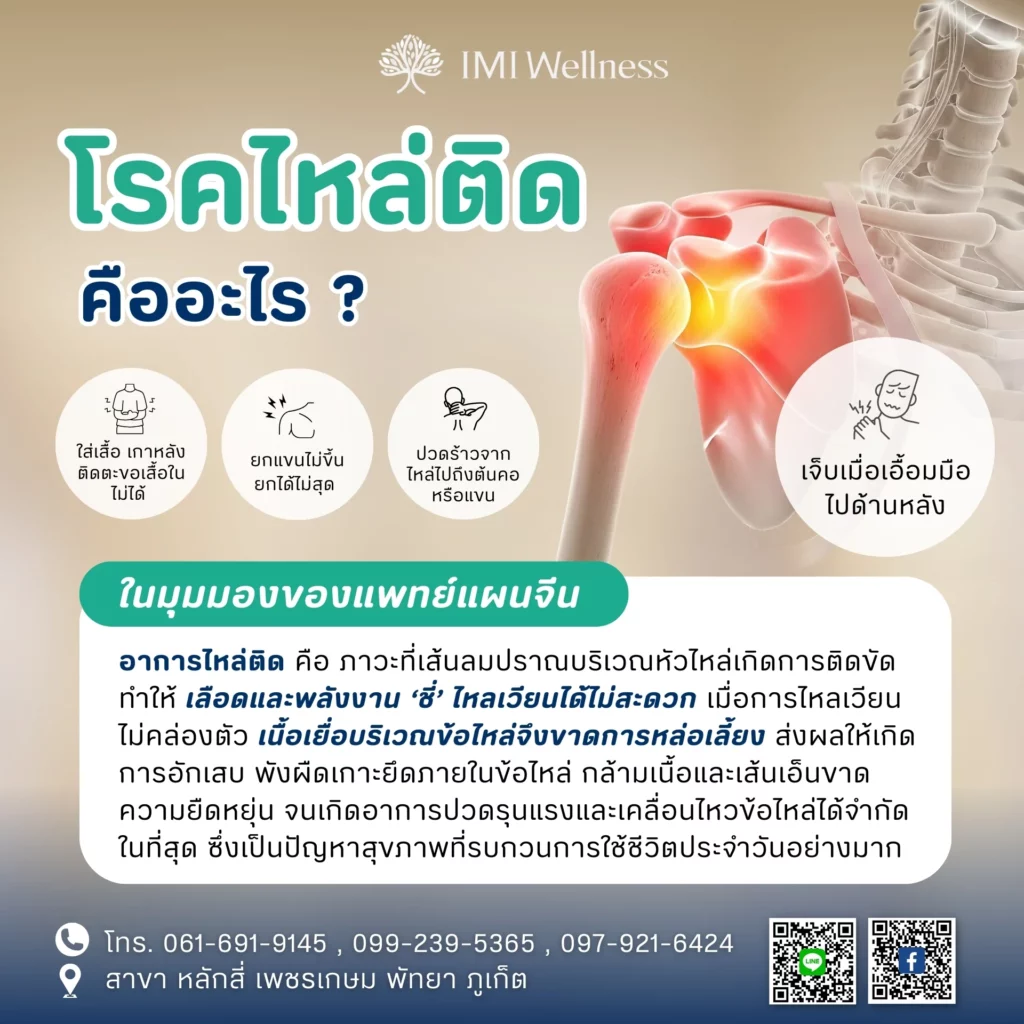 ฝังเข็มไหล่ติด