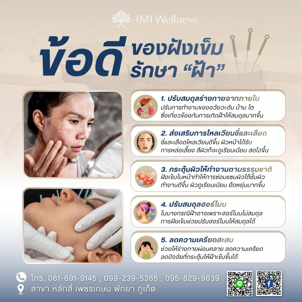 อินโฟกราฟิกข้อดีของการฝังเข็มรักษาฝ้า