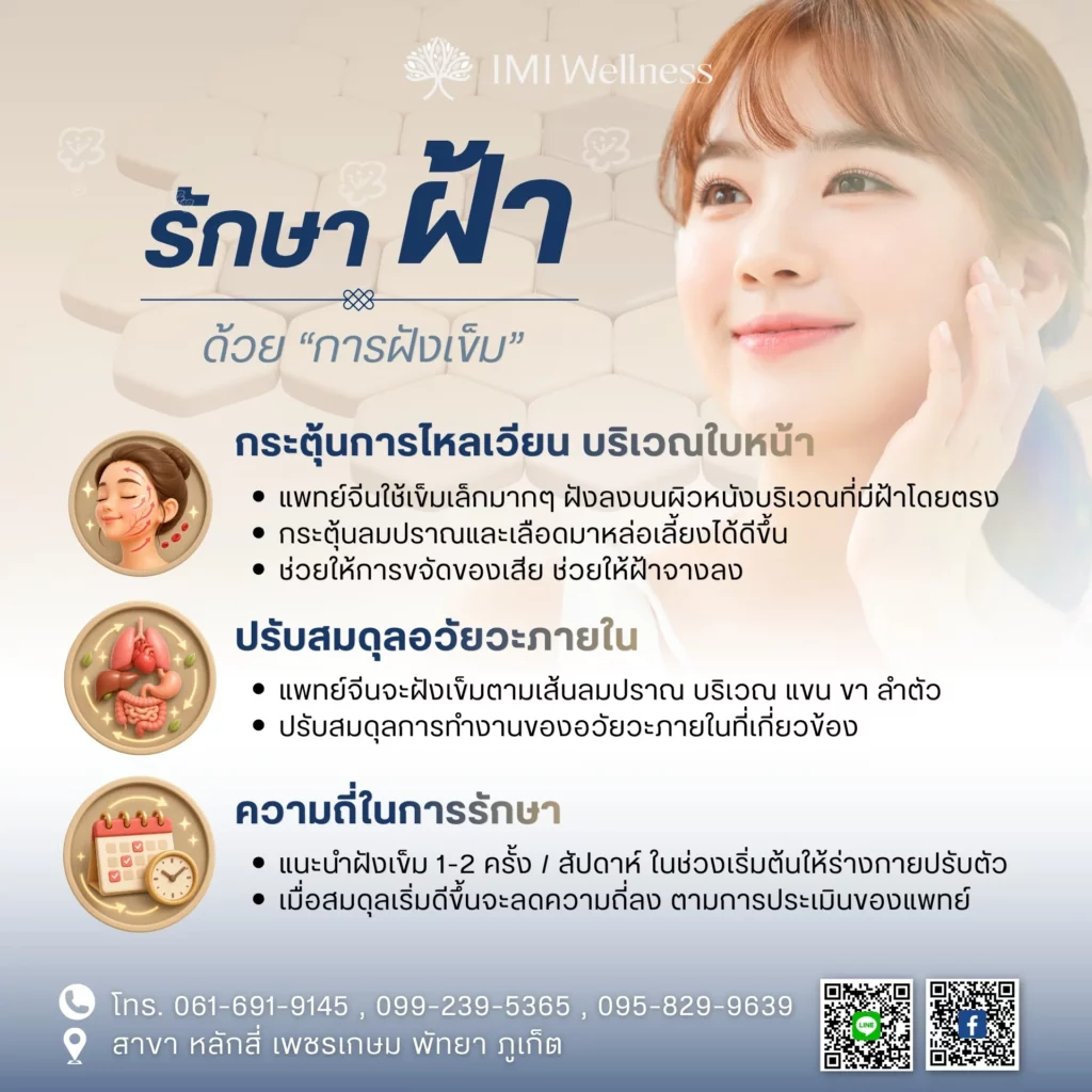 อินโฟกราฟิกวิธีรักษาฝ้าด้วยการฝังเข็ม