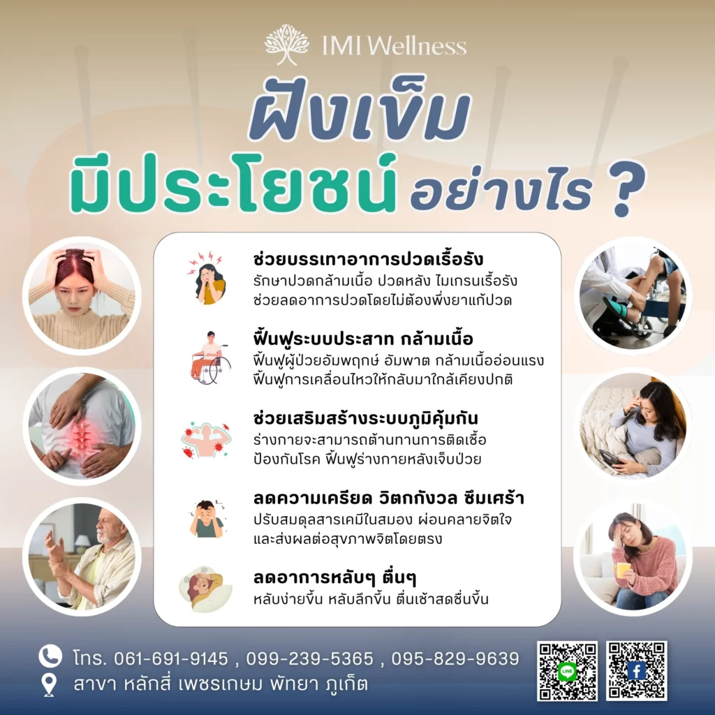 อินโฟกราฟิกประโยชน์ของการฝังเข็มปรับสมดุล