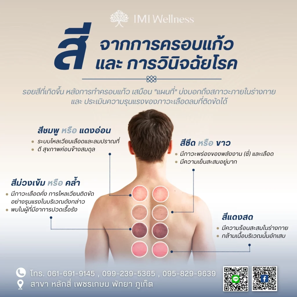 อินโฟกราฟิกสีรอยครอบแก้วและความหมายในการวินิจฉัยตามแพทย์จีน
