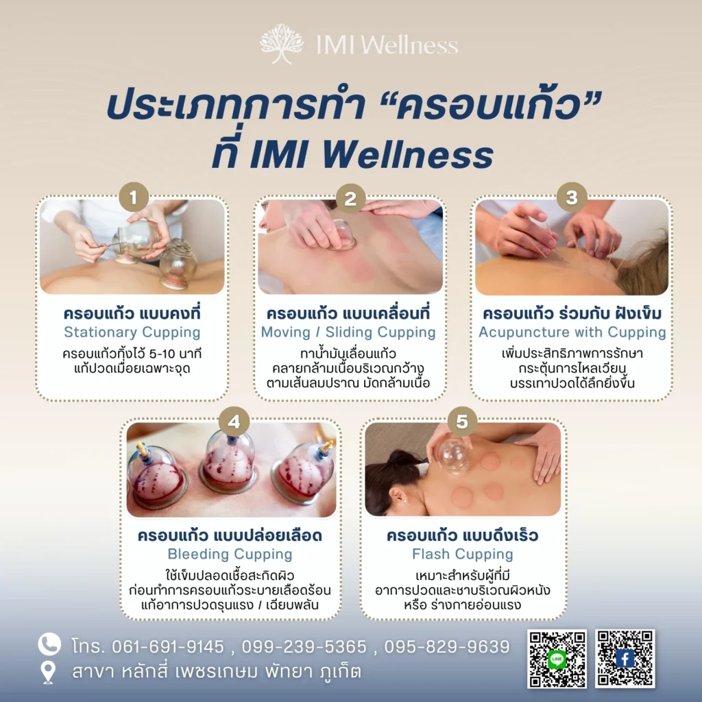 อินโฟกราฟิกประเภทการครอบแก้ว 5 รูปแบบที่ IMI Wellness