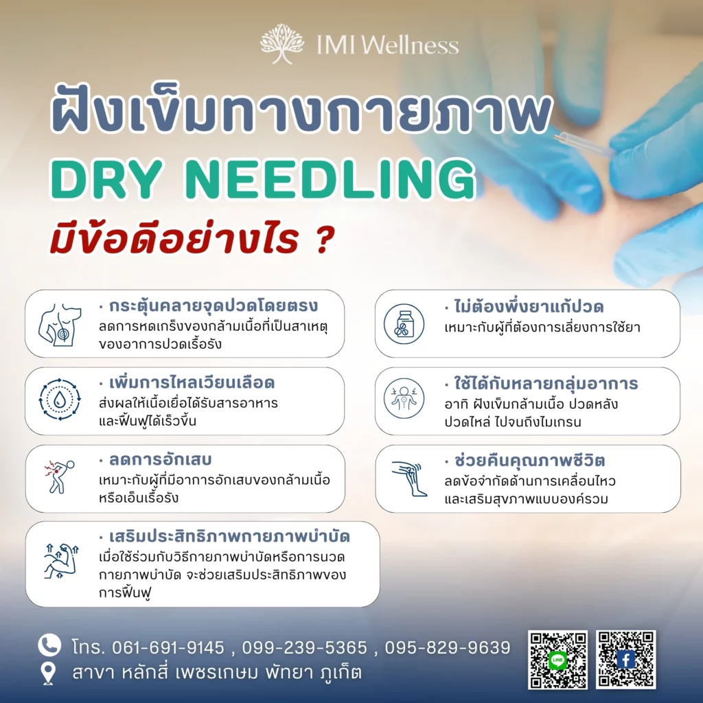 อินโฟกราฟิกข้อดีของฝังเข็มกายภาพ Dry Needling