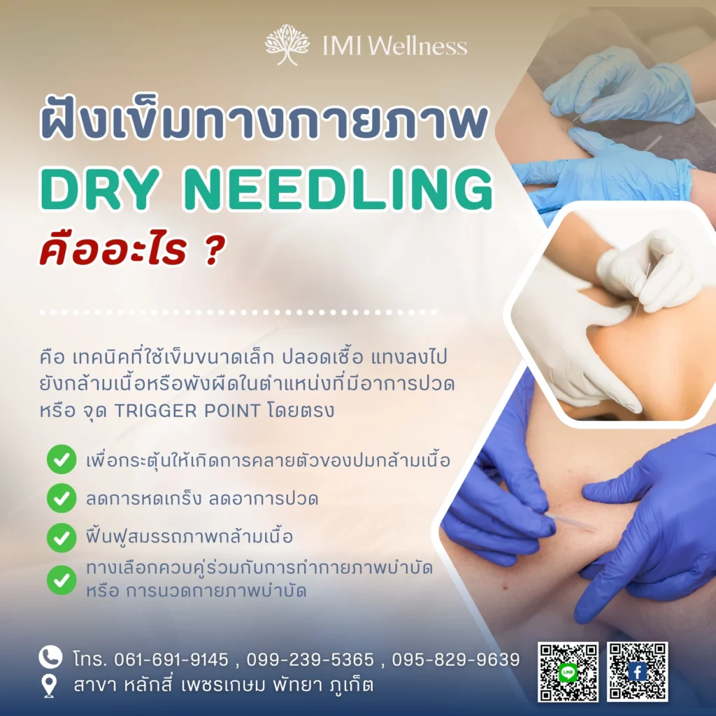 อินโฟกราฟิกอธิบายฝังเข็มกายภาพ Dry Needling คืออะไร