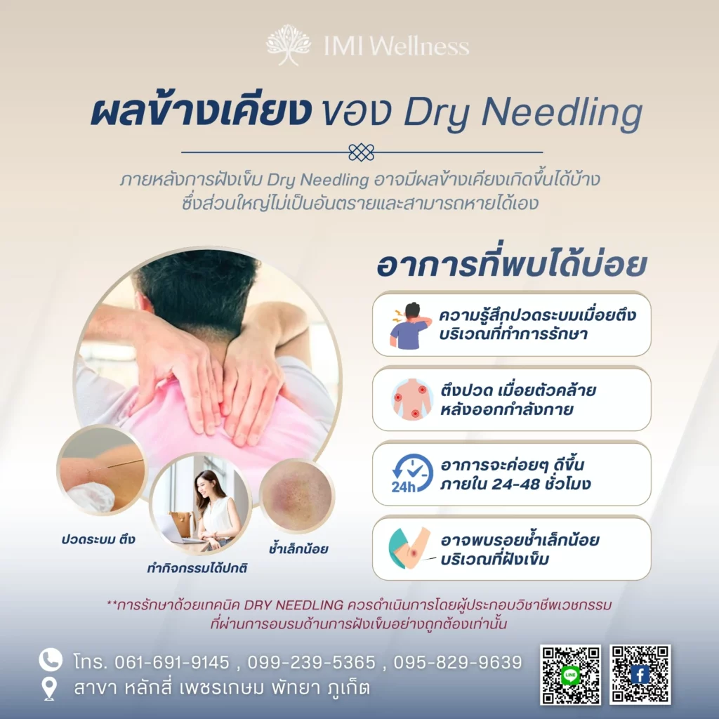 อินโฟกราฟิกผลข้างเคียงของ Dry Needling