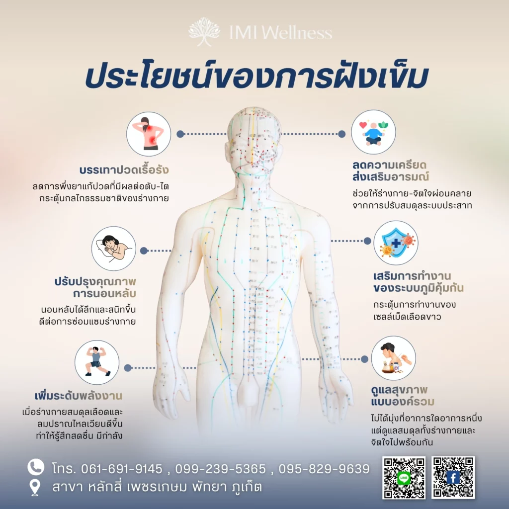 ประโยชน์ของการฝังเข็ม