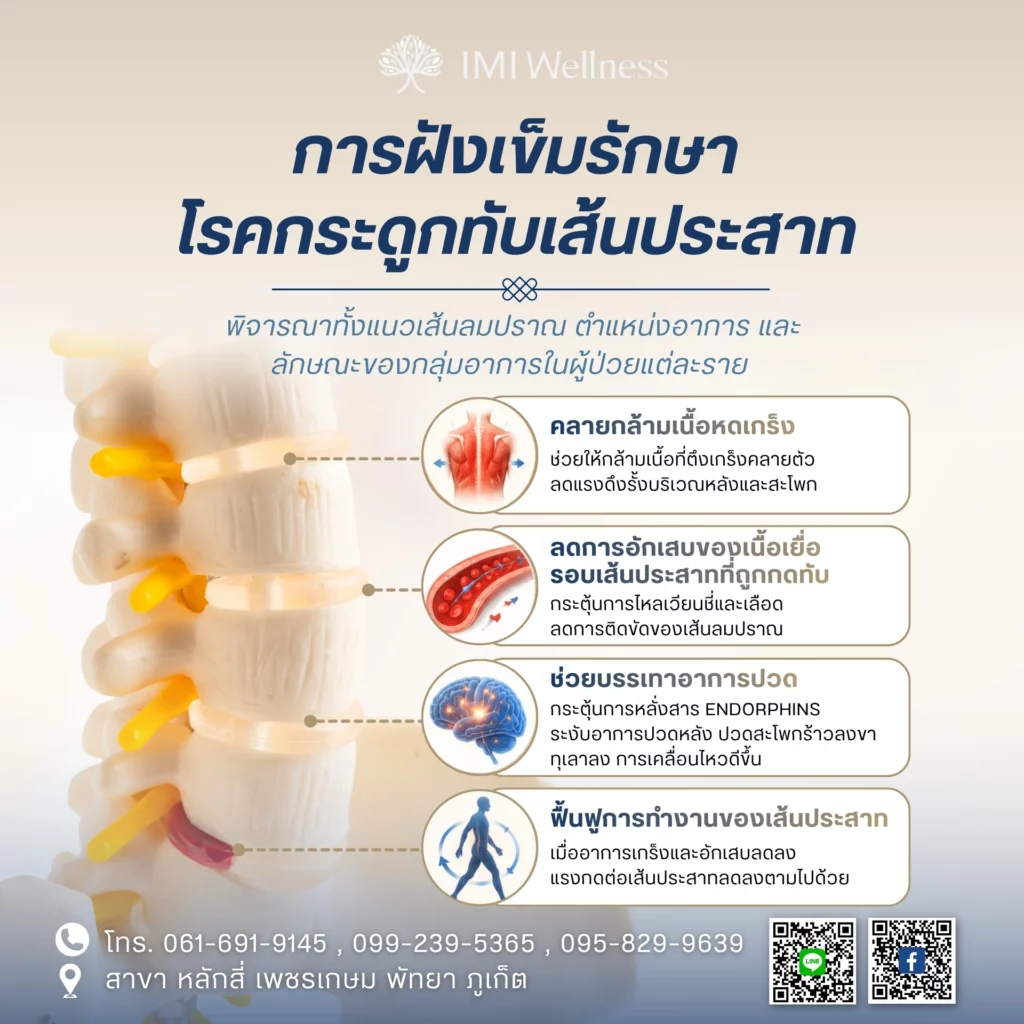การฝังเข็มทำงานอย่างไรกับโรคกระดูกทับเส้นประสาท