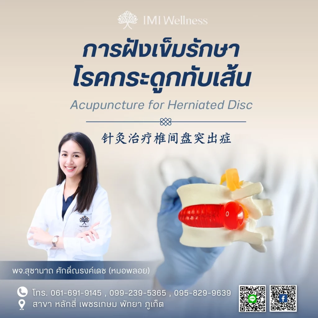 การฝังเข็มรักษาโรคกระดูกทับเส้น โดยแพทย์จีนสุชานาถ ศักดิ์ณรงค์เดช