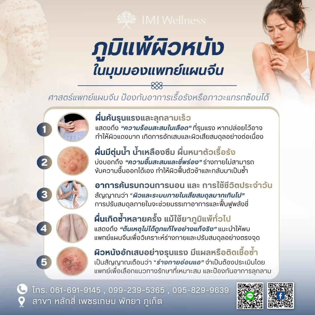 อินโฟกราฟิกสัญญาณภูมิแพ้ผิวหนังที่ควรปรึกษาแพทย์แผนจีน