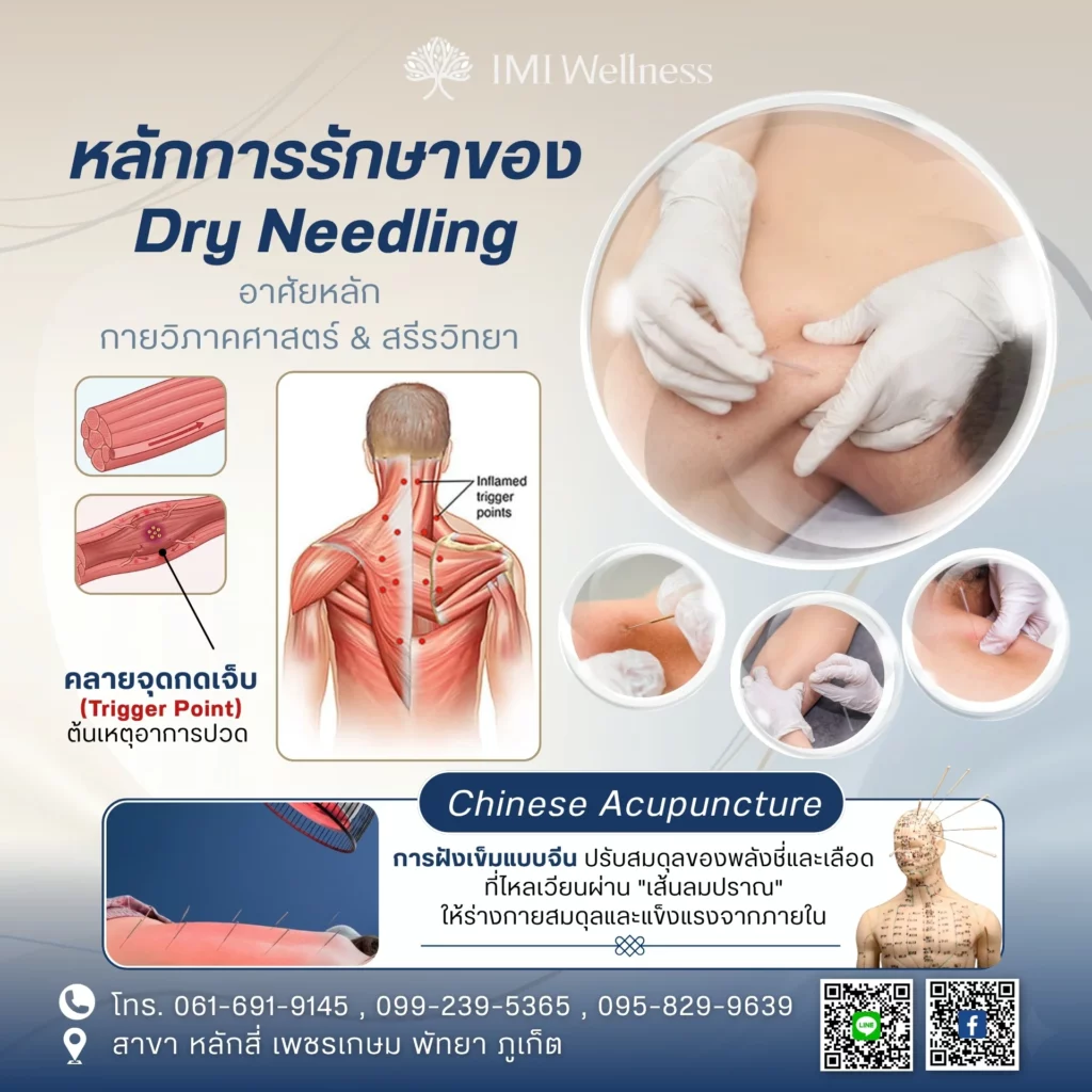อินโฟกราฟิกหลักการรักษาด้วย Dry Needling และการฝังเข็มแบบจีน