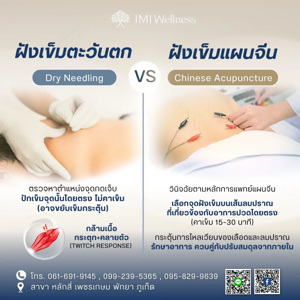 อินโฟกราฟิกเปรียบเทียบ Dry Needling กับการฝังเข็มแบบจีน