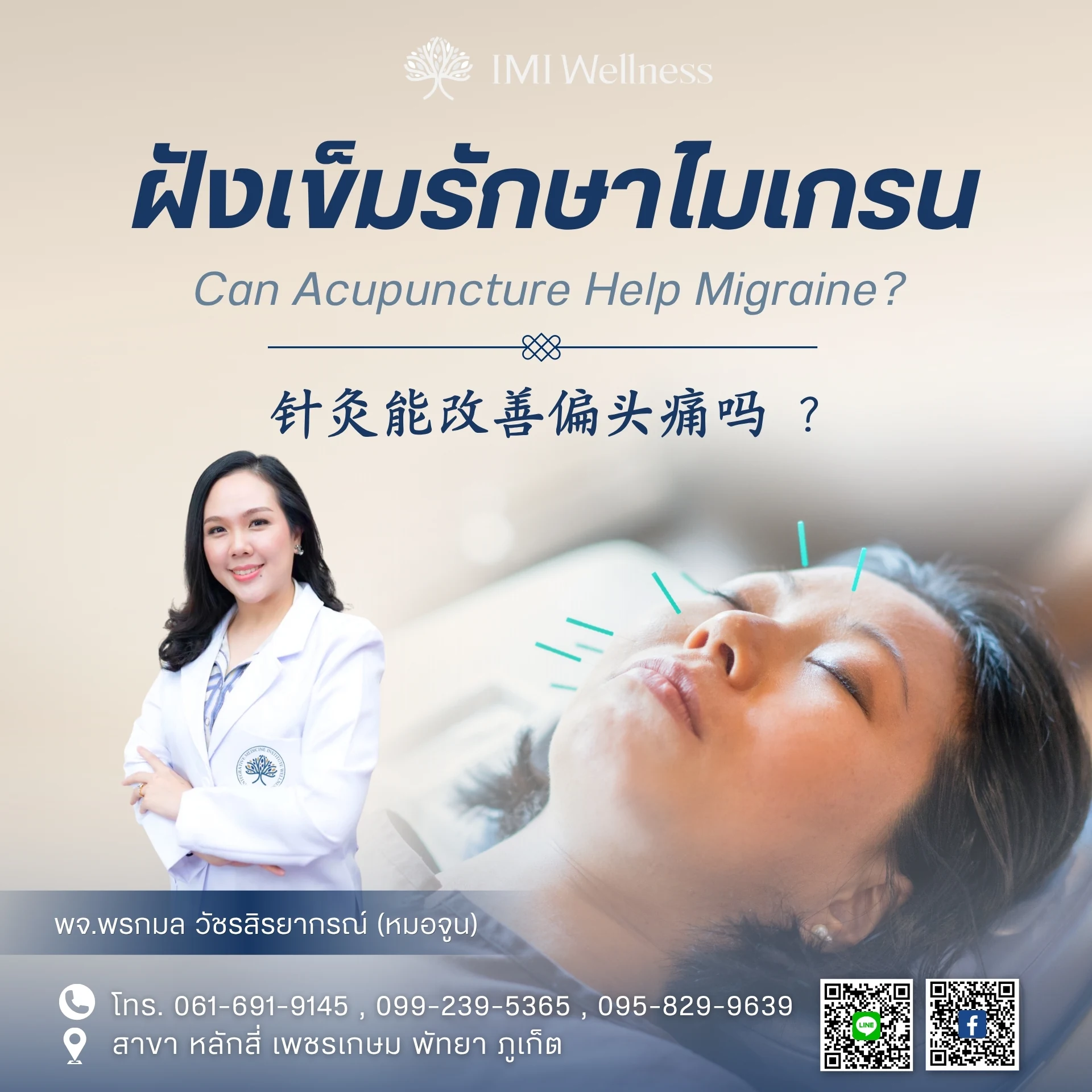 ฝังเข็มรักษาไมเกรน