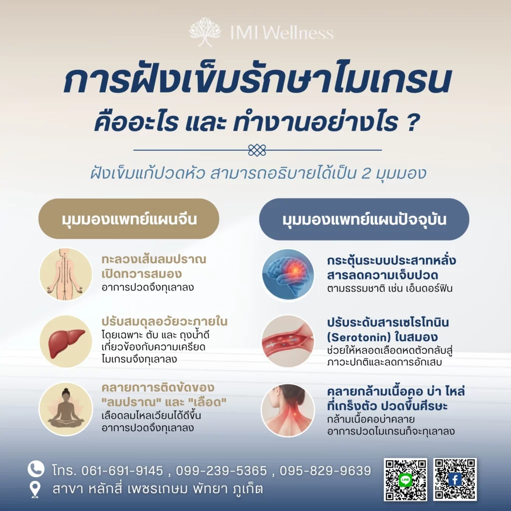 การฝังเข็มรักษาไมเกรนทำงานอย่างไร
