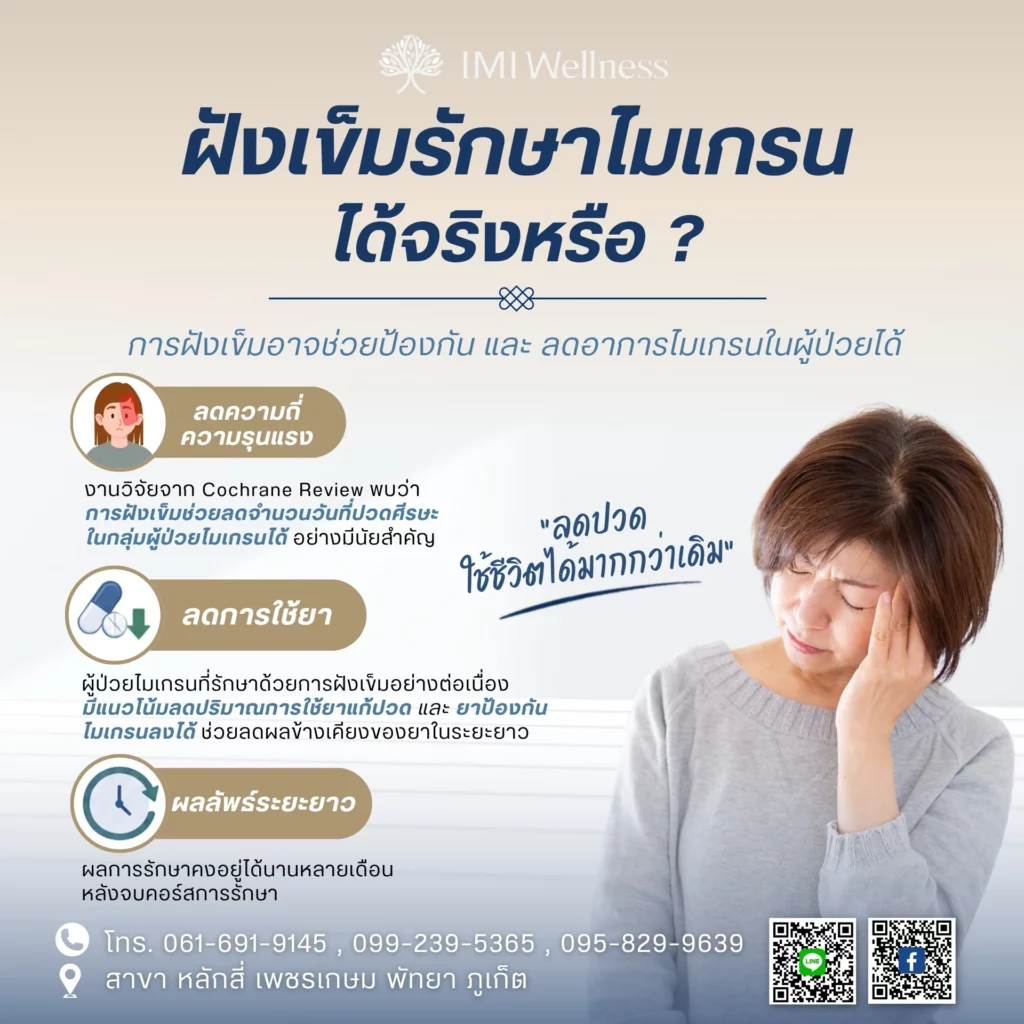 หลักฐานเกี่ยวกับการฝังเข็มรักษาไมเกรน