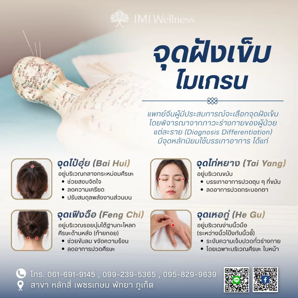 จุดฝังเข็มที่เกี่ยวข้องกับไมเกรน