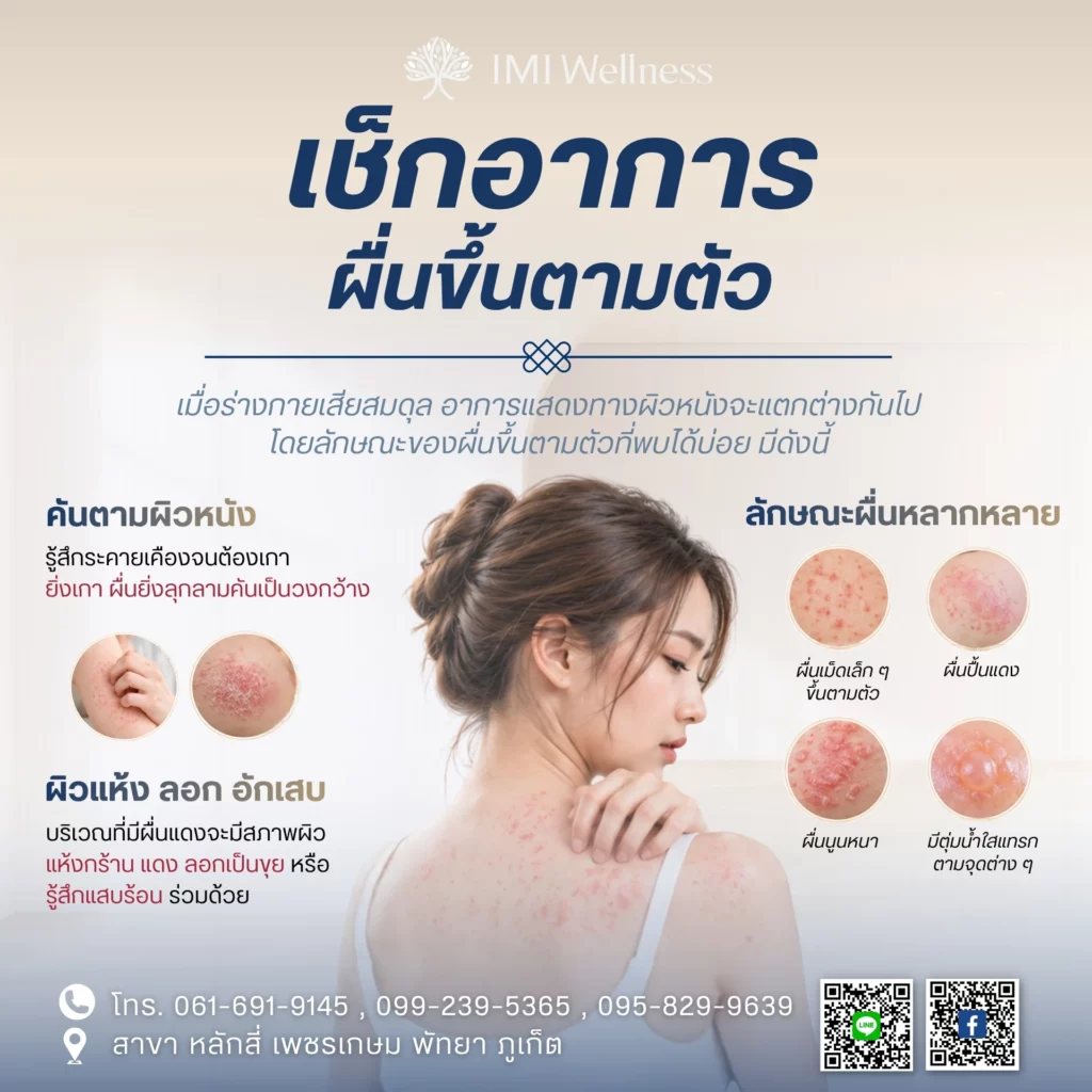 เช็กอาการผื่นขึ้นตามตัวของคุณ