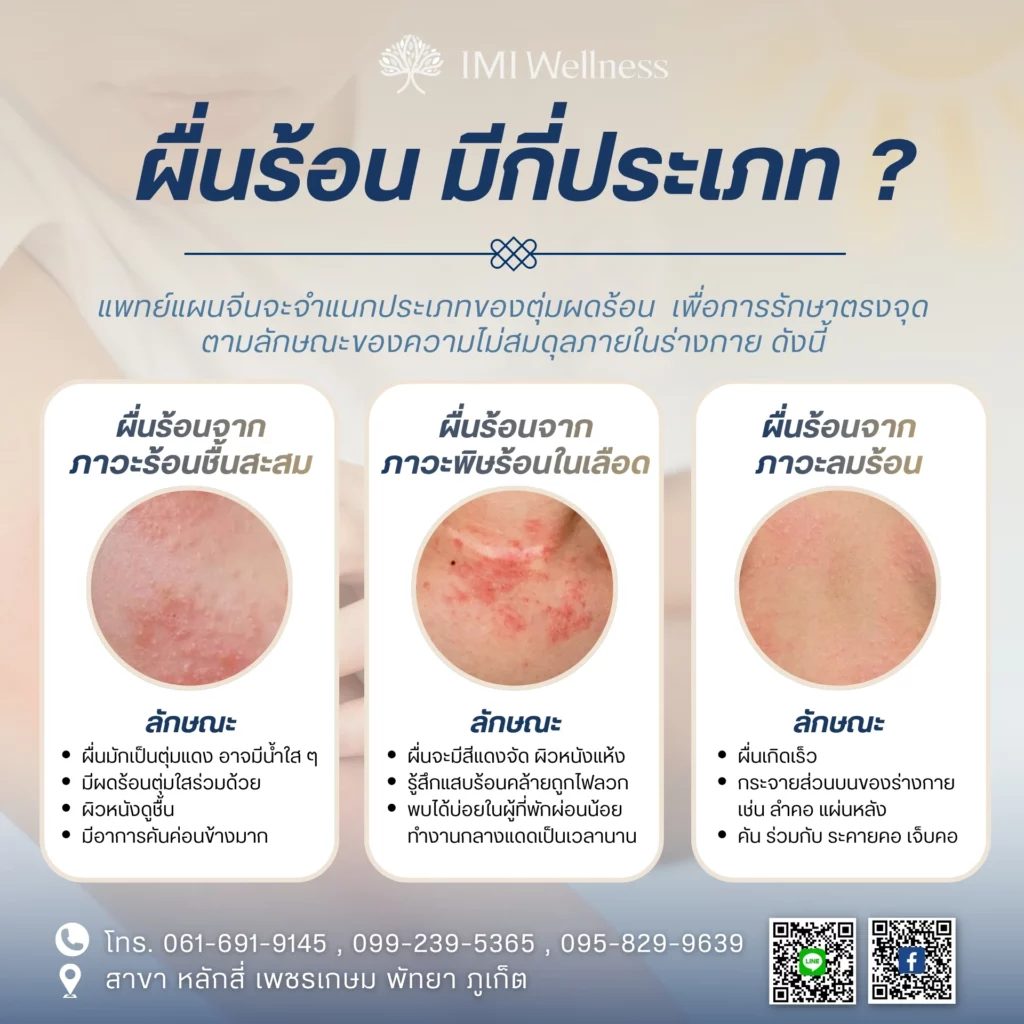 ผื่นร้อน มีกี่ประเภท?