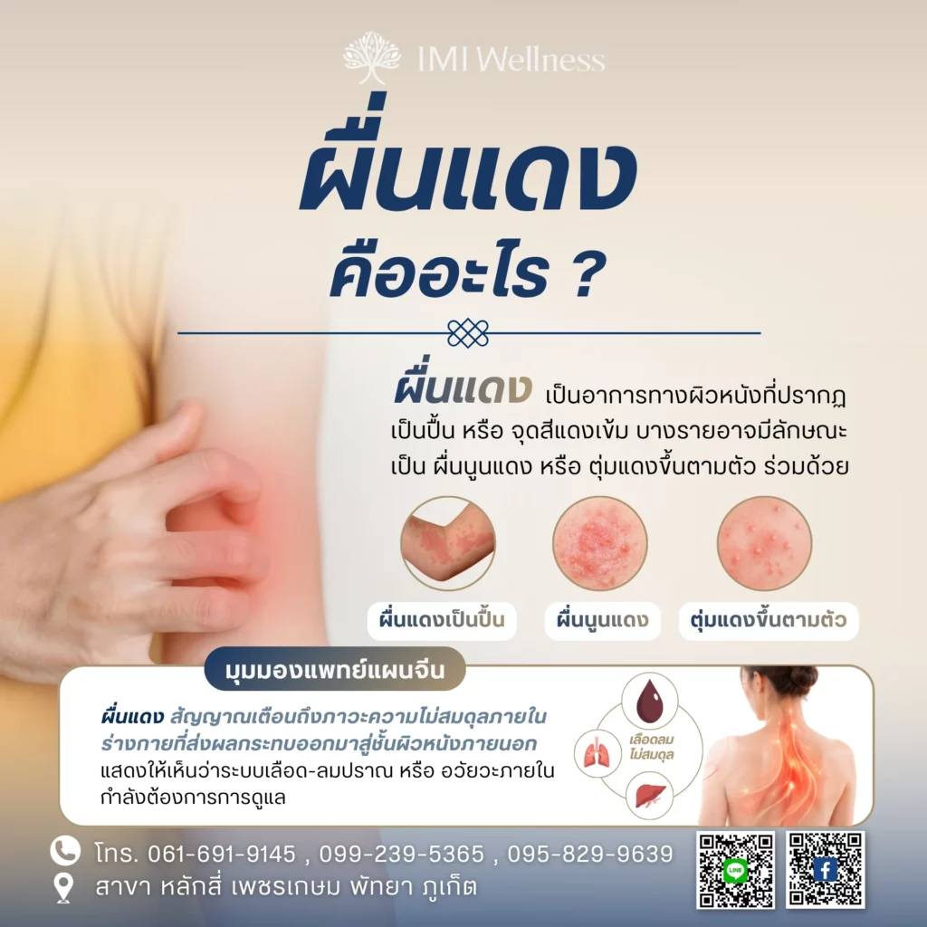 ผื่นแดง คืออะไร?