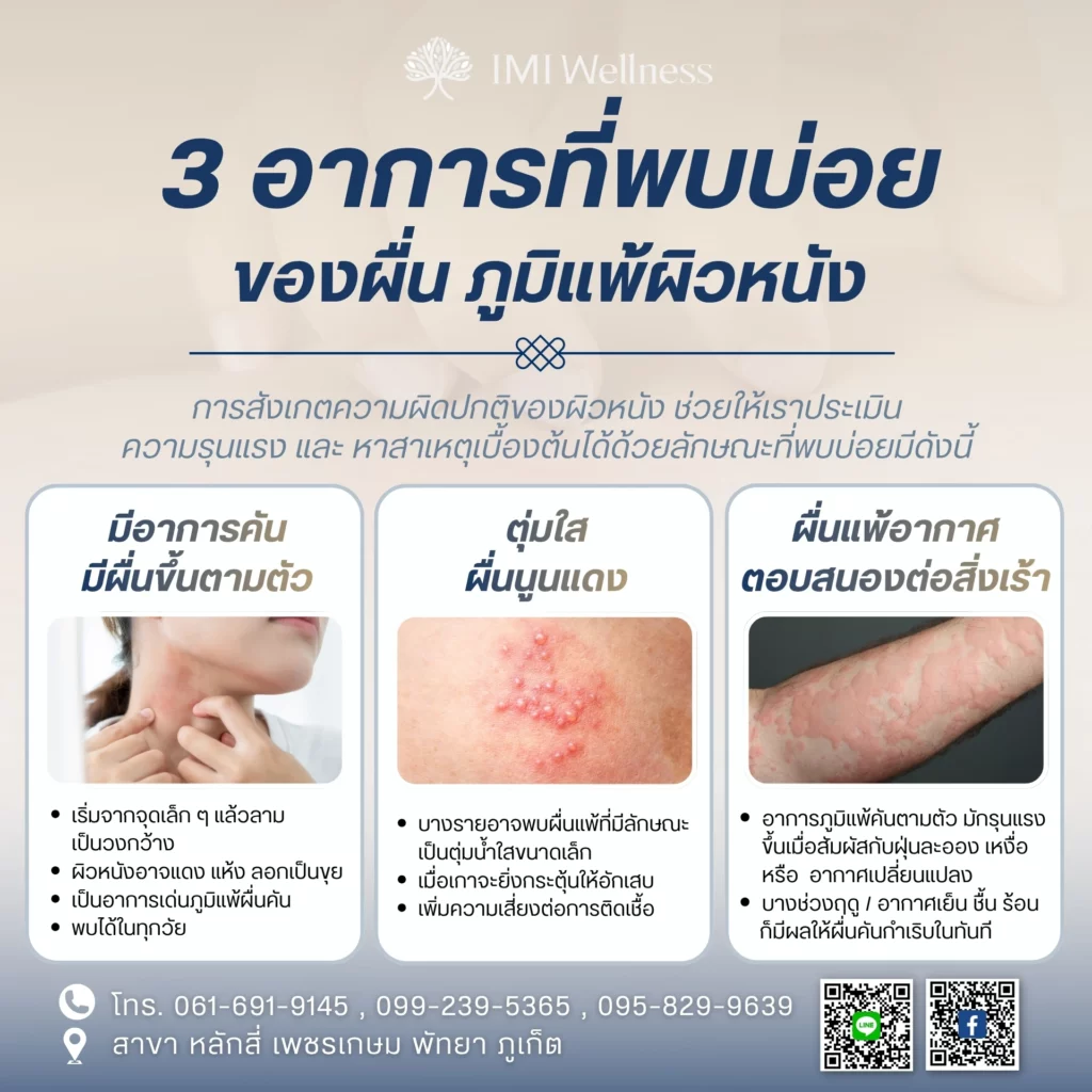 3 อาการ ผื่น ภูมิแพ้ ผิวหนังที่พบบ่อย