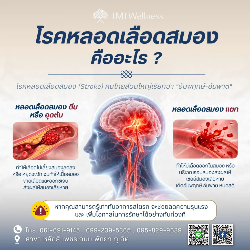 โรคหลอดเลือดสมองคืออะไร